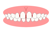歯のすき間